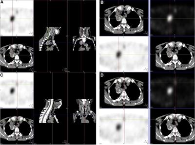 Case report: Reoperative parathyroidectomy for large ectopic hyperplastic parathyroid in the mediastinum of a patient with recurrent secondary hyperparathyroidism